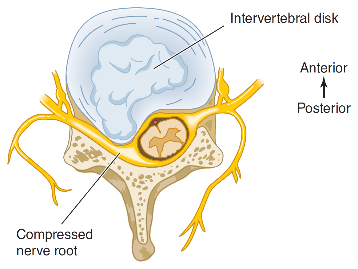 Corte de vértebra con un disco intervertebral herniado que comprime la raíz nerviosa